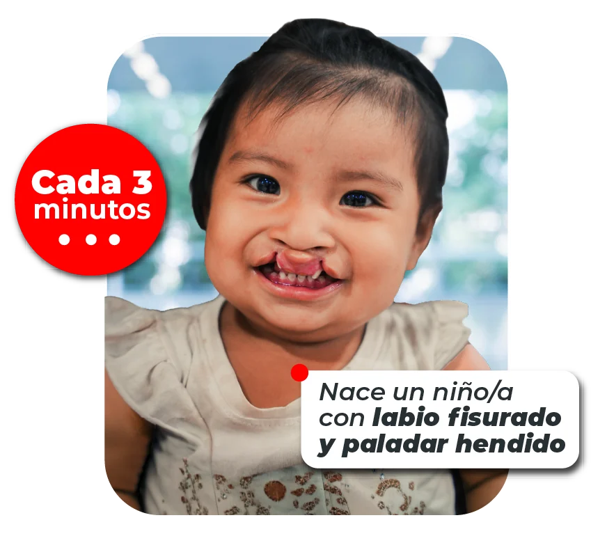 Bebé con labio fisurado sonriendo. Cada 3 minutos nace un niño o una niña con labio fisurado y paladar hendido.