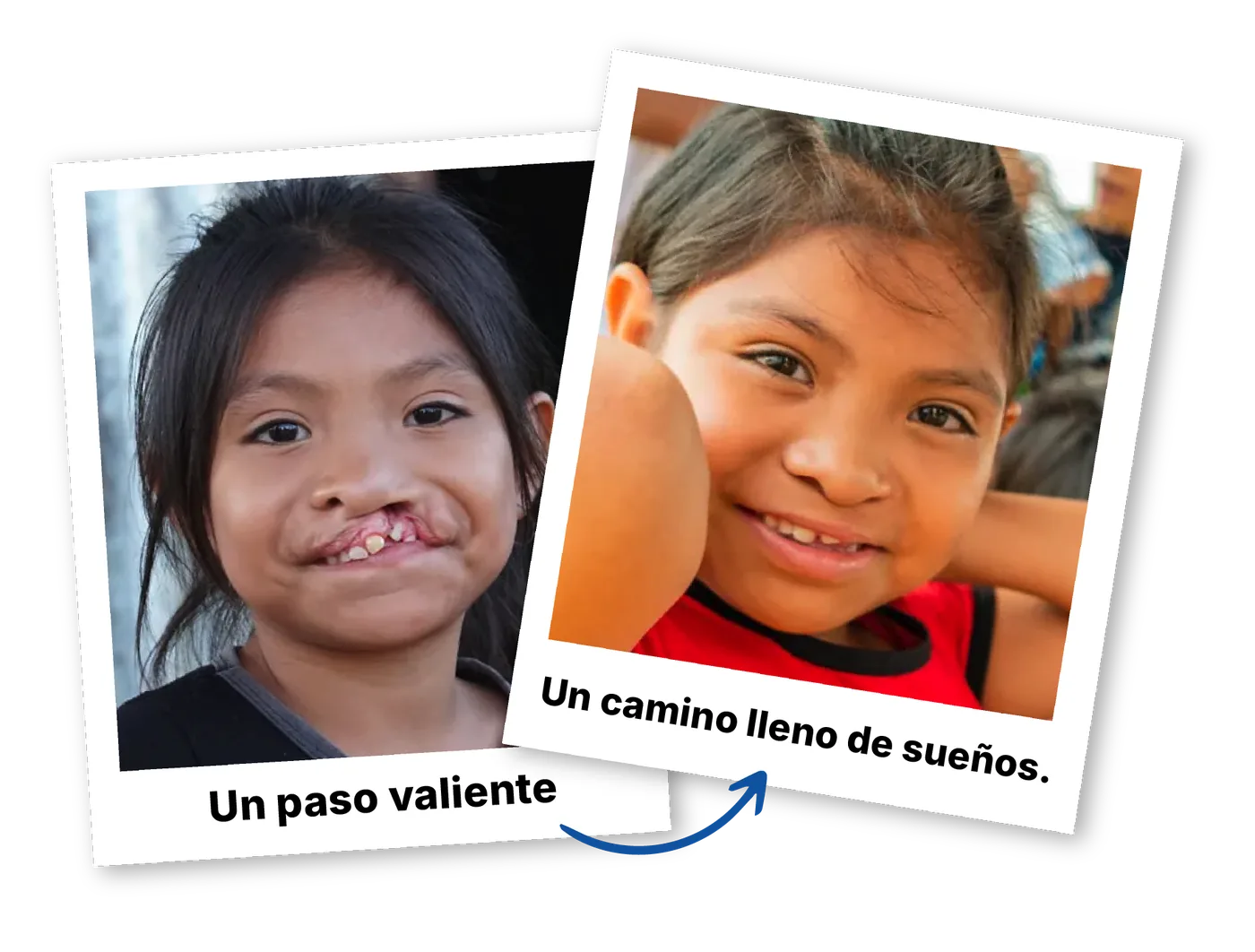 Dos fotos de una niña: antes de su cirugía, “Un paso valiente”, y después, sonriendo, “Un camino lleno de sueños”.