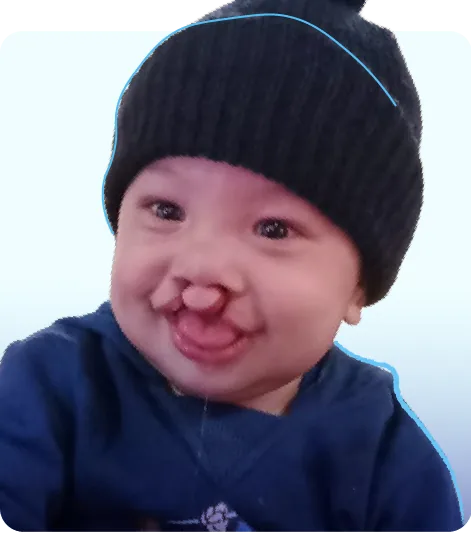 Dabian, bebé con labio fisurado, con un gorro negro.