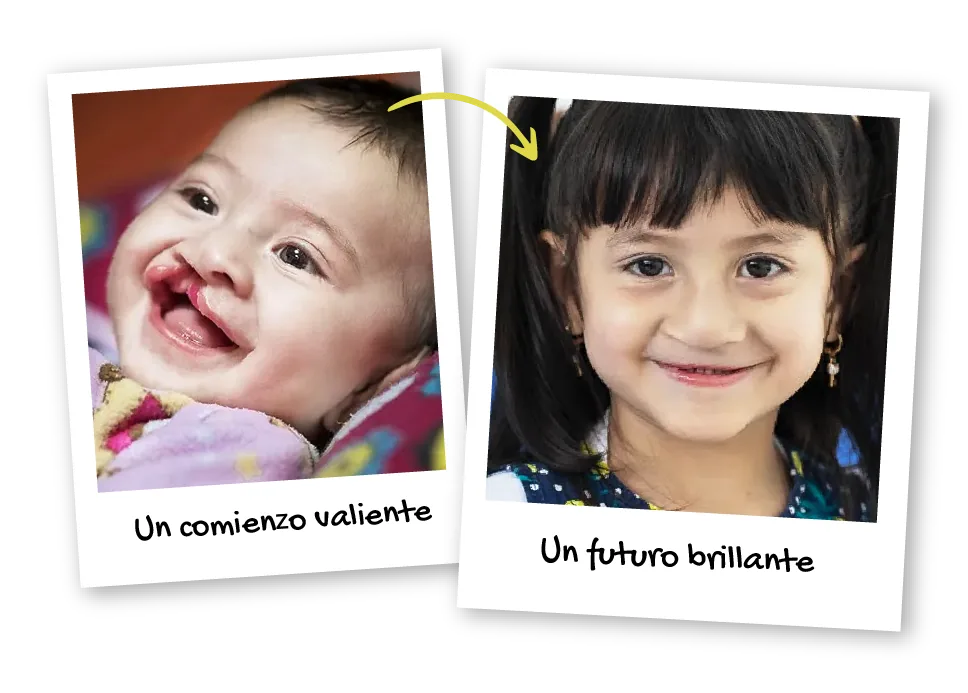 Dos fotos: una bebé con labio fisurado, “Un comienzo valiente”, y una niña sonriendo tras su cirugía, “Un futuro brillante”.