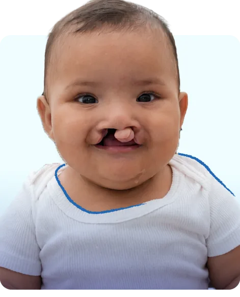 Isabela, bebé con labio fisurado, sonriendo.