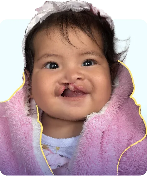Noah, bebé con labio fisurado, abrigada con una manta rosada.