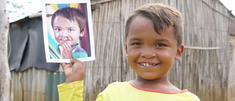 En medio de la crisis migratoria, las sonrisas sanan - Fundación Operación Sonrisa Colombia