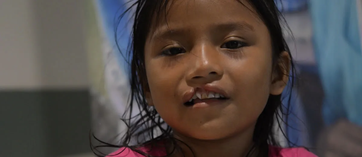 ¿Qué es el labio fisurado y/o paladar hendido? - Fundación Operación Sonrisa Colombia