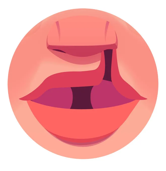 Labio fisurado completo