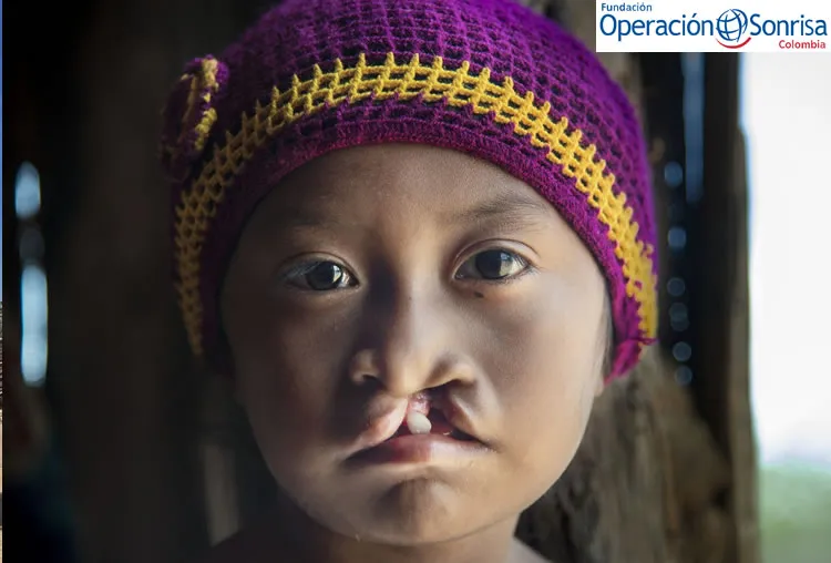Lexxi a la edad de 8 años y nació con la condición de labio fisurado y paladar hendido. Foto: Rohanna Mertens.