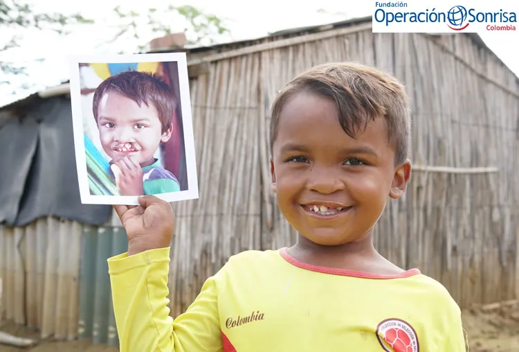 Pedro de 9 años, luego de su cirugía.